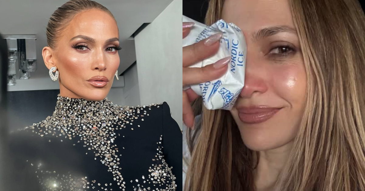 Jennifer Lopez sofre acidente em ensaio de premiação e leva pontos no rosto; veja fotos
