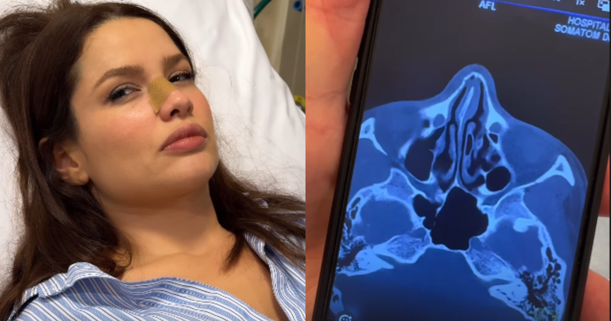 Juliette sofre acidente doméstico e fratura o nariz: 'Já chorei que só'