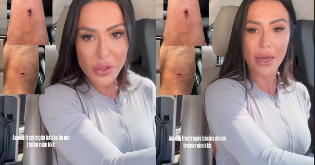 Gracyanne Barbosa sofre acidente e mostra fotos pelo Instagram
