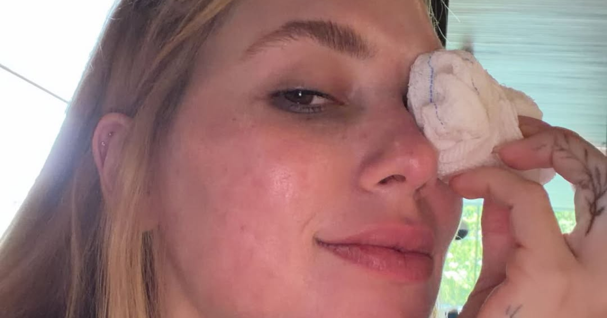 Virginia aparece com lesão no olho após acidente com a filha: 'Cara toda arregaçada'