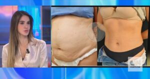 "Combina várias cirurgias e deve ser feito de forma criteriosa": o que é o "mommy makeover"?