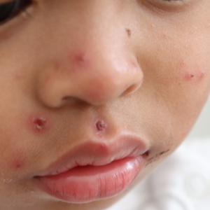 Vacina contra sarampo se torna urgente após Brasil registrar 37 casos e América do Norte enfrentar surto – DiviNews