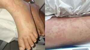 Criança é internada por suspeita de contaminação após uso de detergente