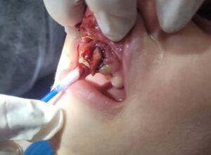 Criança perde dente após acidente em escola; Prefeitura se posiciona • Marília Notícia